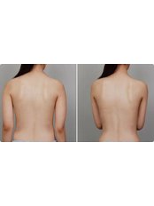 Back Liposuction - Guangzhou Hanfei Medical Cosmetology