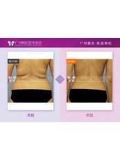 Back Liposuction - Guangzhou Hanfei Medical Cosmetology