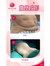 Tummy Tuck - Guangzhou Hanfei Medical Cosmetology