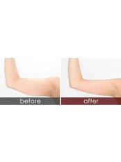Arm Liposuction - Guangzhou Hanfei Medical Cosmetology