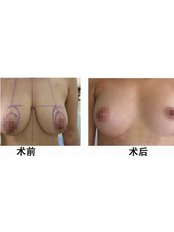 Breast Lift - Guangzhou Hanfei Medical Cosmetology