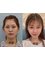 Guangzhou Hanfei Medical Cosmetology - fat transfer to whole face 