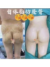 Butt Lift - Guangzhou Hanfei Medical Cosmetology