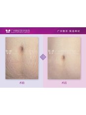 Stretch Marks Removal - Guangzhou Hanfei Medical Cosmetology