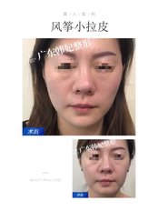 Thread Lift - Guangzhou Hanfei Medical Cosmetology