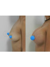 Breast Implants - Cirujano Plastico Yilmar Caviedes