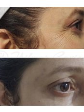 Treatment for Wrinkles - Cirujano Plastico Yilmar Caviedes