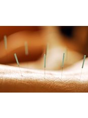 Acupuncture Treatment - Poliklinika Mešter
