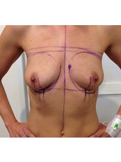 Breast lift + breast augmentation	 - Poliklinika Mešter
