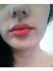 Lip augmentation with injectable fillers  - Poliklinika Mešter
