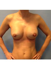 Breast enlargement – tear drop implants	 - Poliklinika Mešter