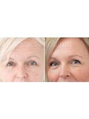 Treatment for Wrinkles - Dr Toncic - Cosmetic Surgery