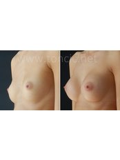 Breast Implants - Dr Toncic - Cosmetic Surgery