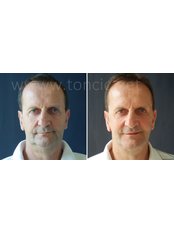 Facelift - Dr Toncic - Cosmetic Surgery
