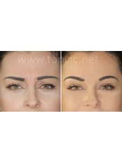 Treatment for Wrinkles - Dr Toncic - Cosmetic Surgery