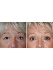 Blepharoplasty - Dr Toncic - Cosmetic Surgery