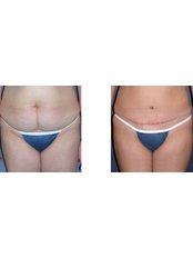 Tummy Tuck - Cyprus Sun Med Connections