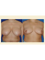 Breast Reduction - Cyprus Sun Med Plastic Surgery
