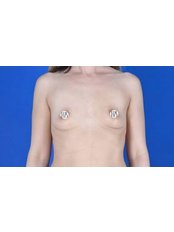 Breast Implants - Dr. Demetris Stavrou Limassol