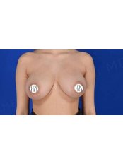 Breast Reduction - Dr. Demetris Stavrou Limassol