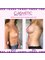 Cosmetic Surgery Cyprus - Breast Augmentation Before and After 