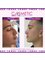 Cosmetic Surgery Cyprus - Rhinoplasty Before and After 