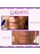Cosmetic Surgery Cyprus - Facelift Before and After 