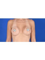 Breast Implants - Dr. Demetris Stavrou - European Institute of Plastic Surgery