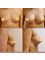 Dr Kitsios Christos - breast implants dr Kitsios 