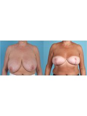 Breast reduction  - Martin Paciorek