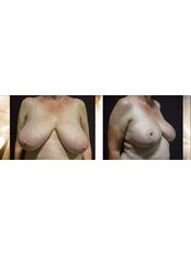Breast Reduction - Formé Clinic