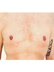 Gynecomastia (with and without liposuction) - Prague Medical Institute - Plastic Surgery