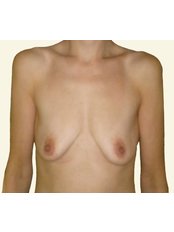Breast Lift - Prague Medical Institute - Plastic Surgery