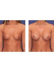 Breast Implants - Prague Medical Institute - Plastic Surgery