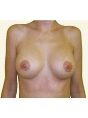 Breast Lift - Prague Medical Institute - Plastic Surgery