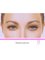 Your help to Beauty - Blepharoplasty is one of the most asked surgery. 