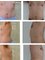 Cirugía Plástica del Caribe - liposuction + mastectomy 