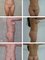 Cirugía Plástica del Caribe - Lipoesculpture + Breast augmentation + buttlift 