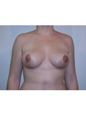postop breast lift - CiruPlastic
