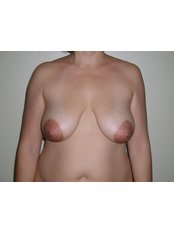 preop breast lift - CiruPlastic
