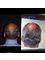 Dr. Eduardo Mejia - hair growth procedure without surgery  