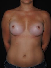 Breast Augmentation - Dr. Eduardo Mejia