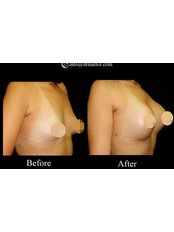 Breast Implants - Dr. Emmanuel Mallol Cotes
