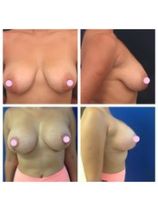 Breast Lift with implants - Dr. Marcos Cuevas Soto