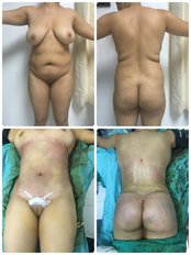 Liposuction - Dr. Marcos Cuevas Soto