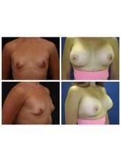 Breast Implants - Dr. Marcos Cuevas Soto