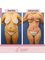 Dra Lourdes Rodríguez - tummy tuck + 360 liposuction 