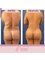 Dra Lourdes Rodríguez - back liposuction 