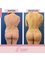 Dra Lourdes Rodríguez - Back liposuction 
