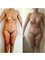 SM Cirugía Plástica - Mommymakeover (Breast lift with implant, tummy tuck, liposuction) 